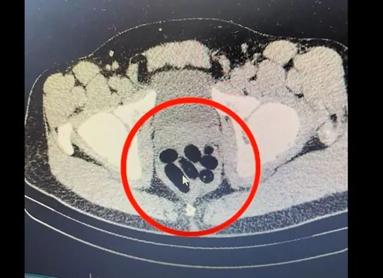 Bu Kadın Çıldırmış Olmalı! Midesinde 500 gram uyuşturucu İle yakalandı — haber görseli