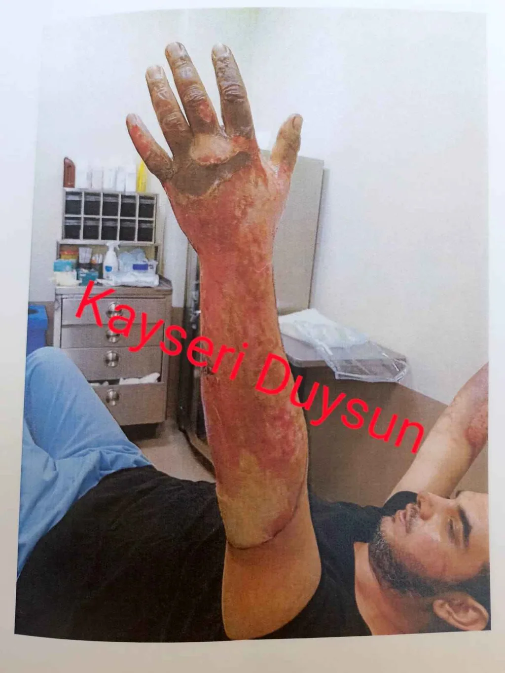 Şevket Ateş’in Ölüm Nedeni: Grip Mi, Kimyasal Yanık Mı? Aile Adalet Arıyor — haber görseli